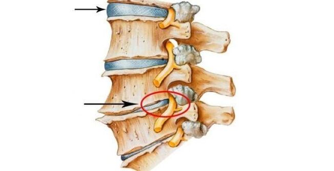 здрав и увреден гръбначен диск с цервикална остеохондроза