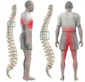 увреждане на гръбначния стълб и болка при гръдна остеохондроза