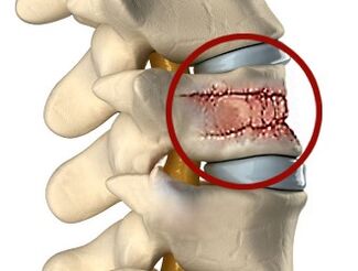 Причините за болки в гърба могат да бъдат заболявания на гръбначния стълб и междупрешленните дискове. 