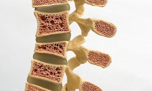 Остеопорозата е една от причините за болки в долната част на гърба