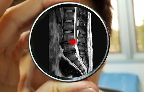 Последицата от пренебрегването на болката в долната част на гърба може да бъде дискова херния. 