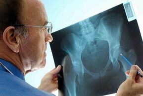 Артроза на тазобедрената става върху x -ray
